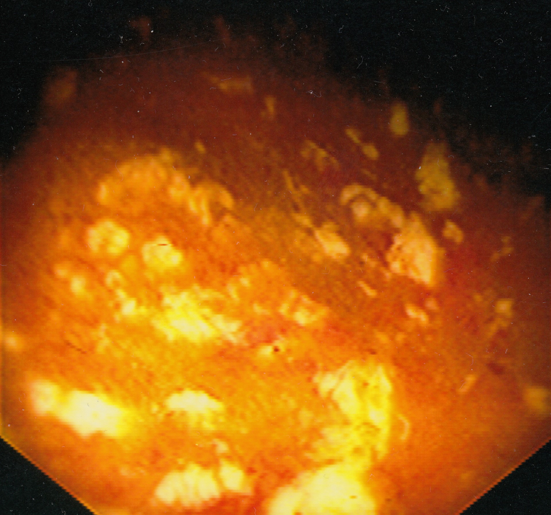Latest Developments in Pseudomembranous Colitis and Treatment